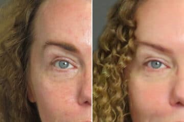 Blepharoplasty Before and After Photos in CA, Irvine, Patient 1549