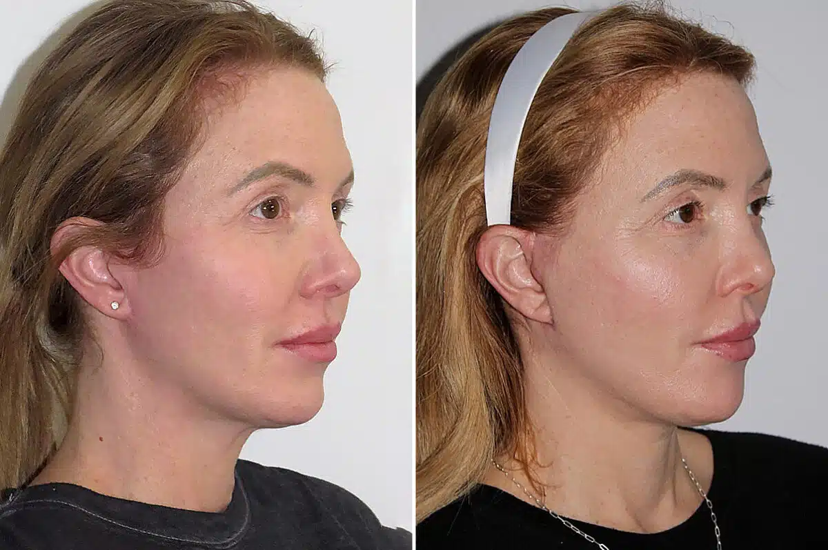 Facelift & Necklift Before and After Photos in CA, Irvine, Patient 1590