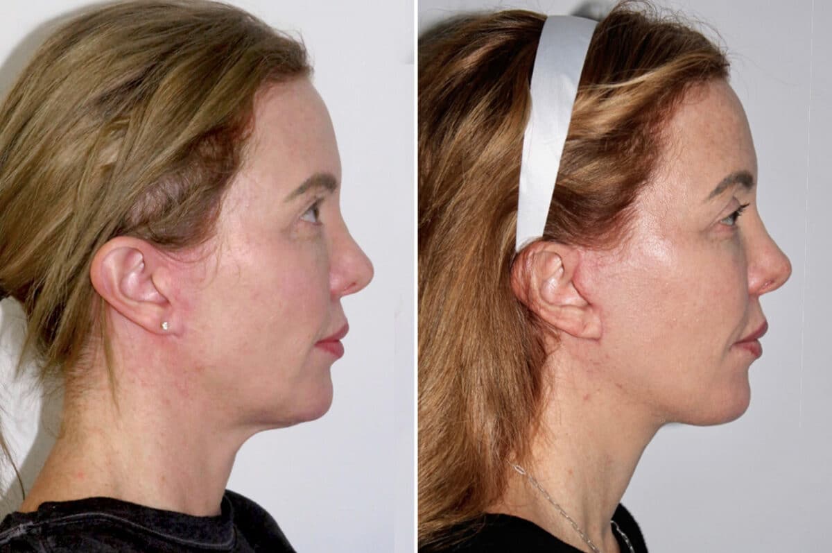 Facelift & Necklift Before and After Photos in CA, Irvine, Patient 1590