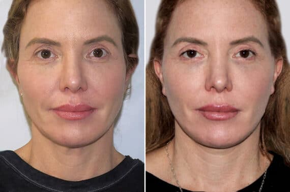 Facelift & Necklift Before and After Photos in CA, Irvine, Patient 1590