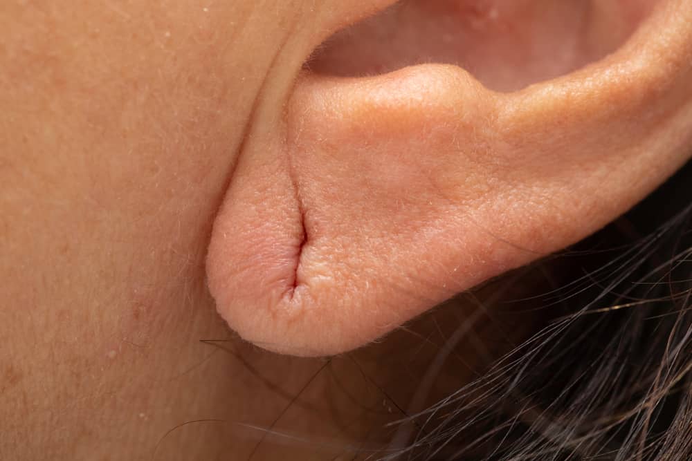 Earlobe reduction is a minimally invasive surgery that is performed under local anesthesia