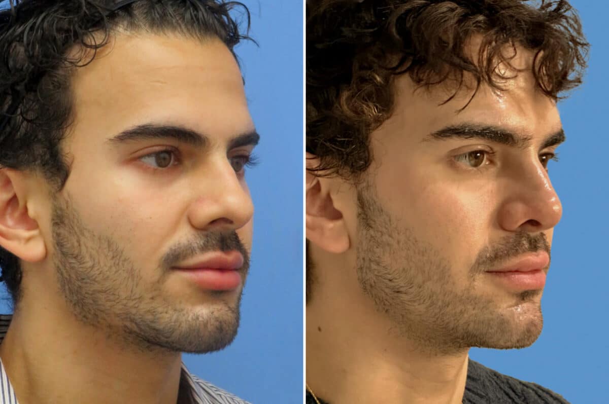 Rhinoplasty Before and After Photos in CA, Irvine, Patient 1556