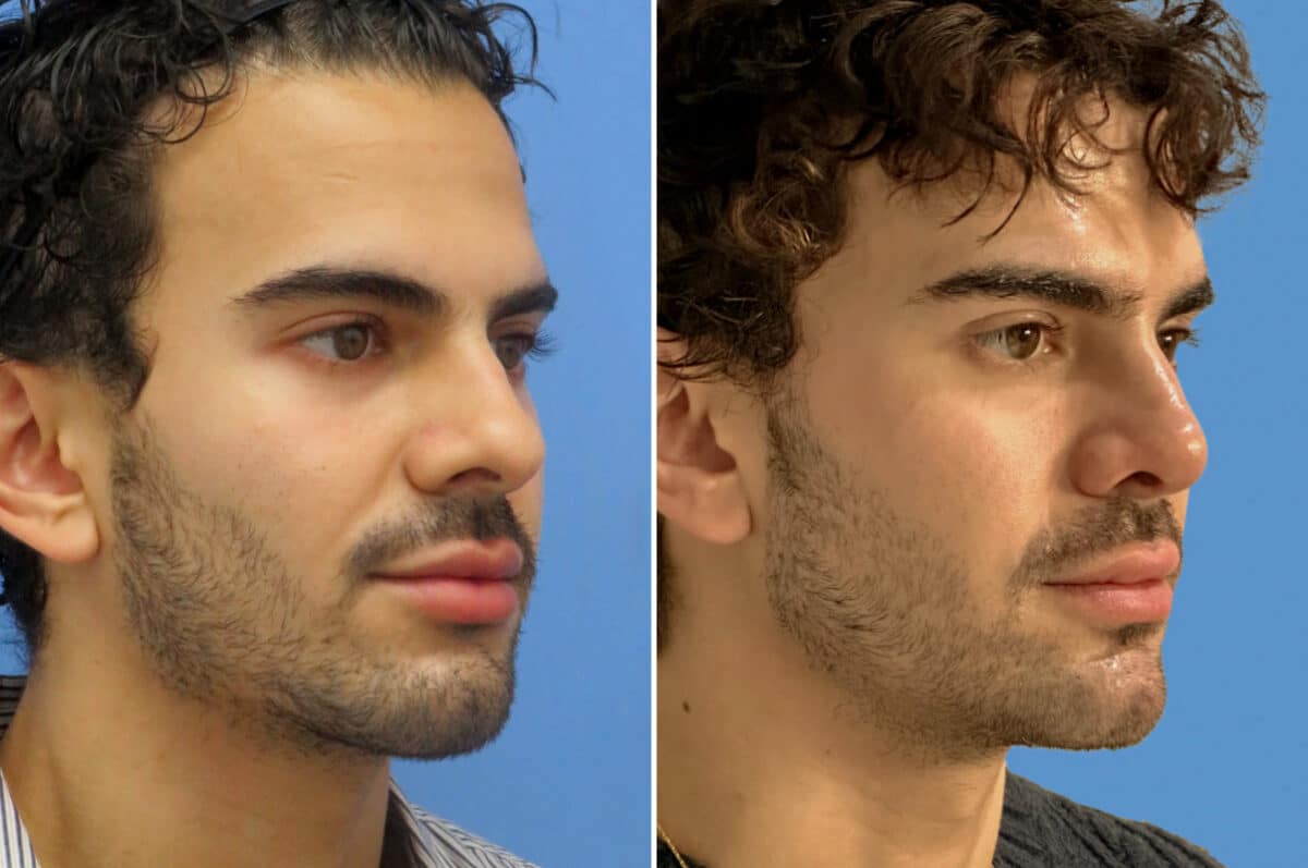 Rhinoplasty Before and After Photos in CA, Irvine, Patient 1556