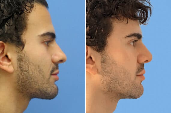 Rhinoplasty Before and After Photos in CA, Irvine, Patient 1556