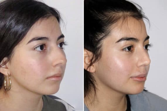 Rhinoplasty Before and After Photos in CA, Irvine, Patient 1627