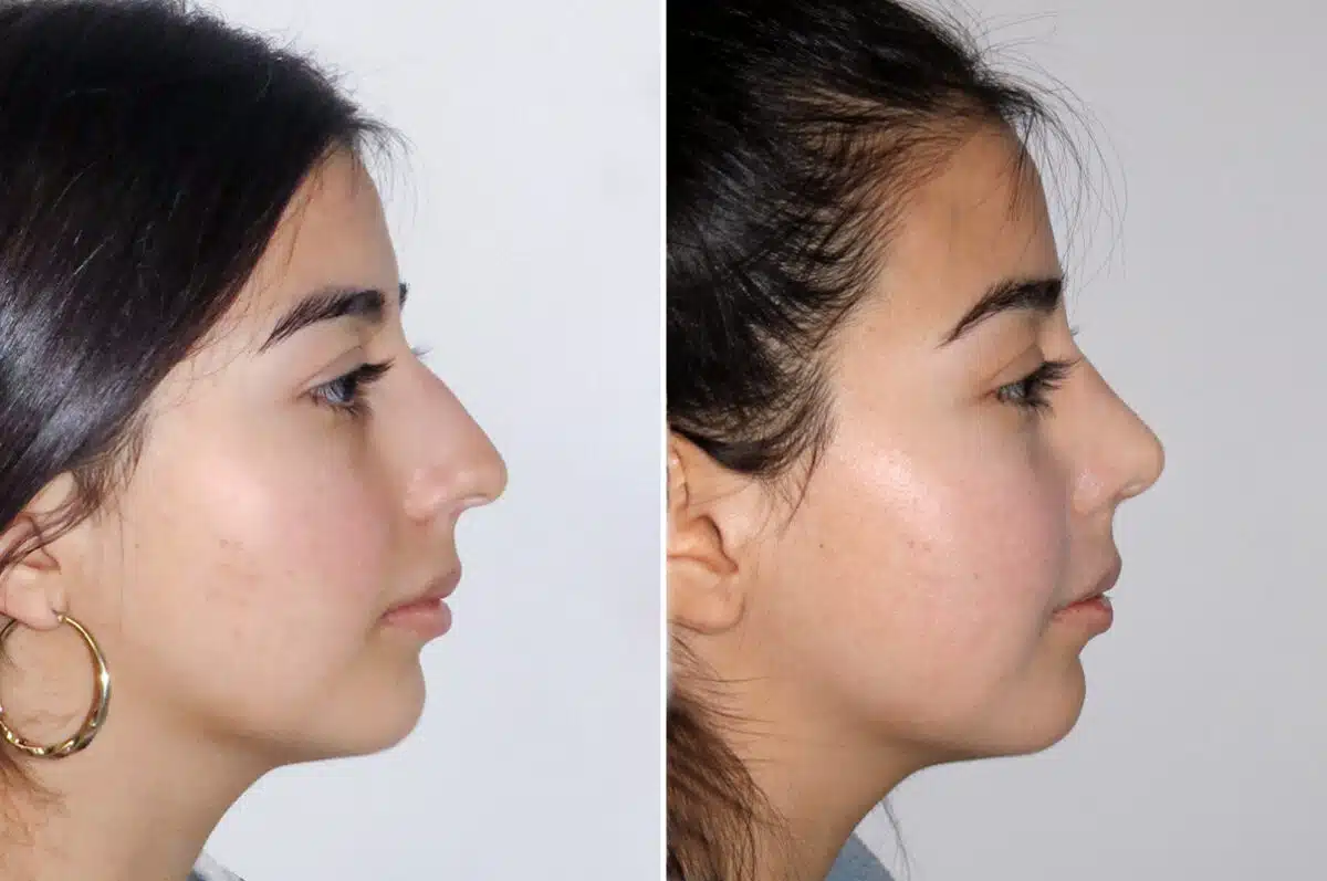 Rhinoplasty Before and After Photos in CA, Irvine, Patient 1627