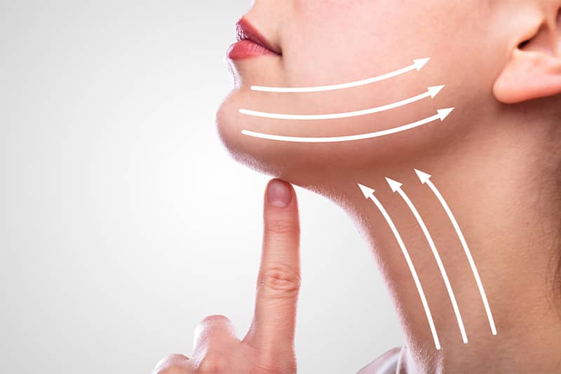 Neck liposuction is a procedure that starts with a very small incision on the underside of the chin