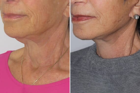 Facelift & Necklift Before and After Photos in CA, Irvine, Patient 1788