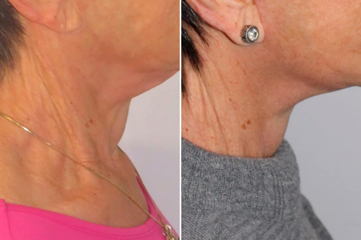 Facelift & Necklift Before and After Photos in CA, Irvine, Patient 1788