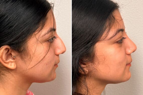 Rhinoplasty Before and After Photos in CA, Irvine, Patient 1923