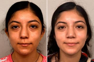 Rhinoplasty Before and After Photos in CA, Irvine, Patient 1923