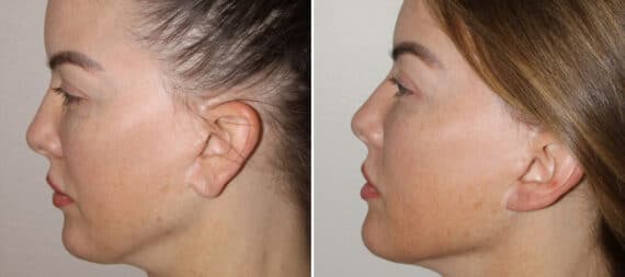 Earlobe Repair Before and After Photos in CA, Irvine, Patient 1930