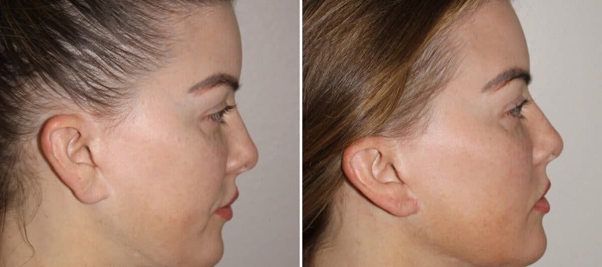 Earlobe Repair Before and After Photos in CA, Irvine, Patient 1930