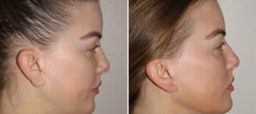 Earlobe Repair Before and After Photos in CA, Irvine, Patient 1930