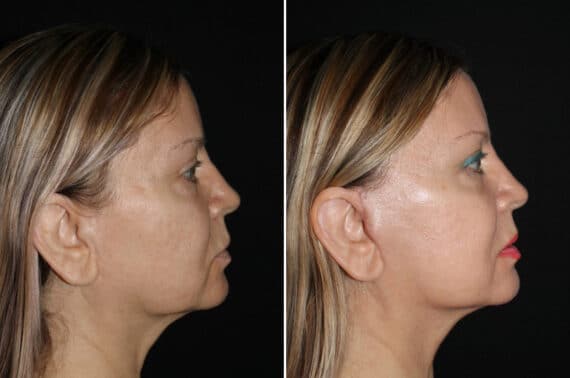 Mini Lift Before and After Photos in CA, Irvine, Patient 2010