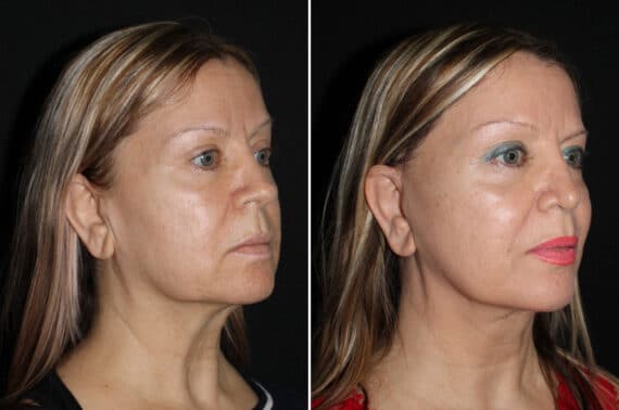 Mini Lift Before and After Photos in CA, Irvine, Patient 2010