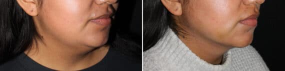 Double Chin Lipo Before and After Photos in CA, Irvine, Patient 2036