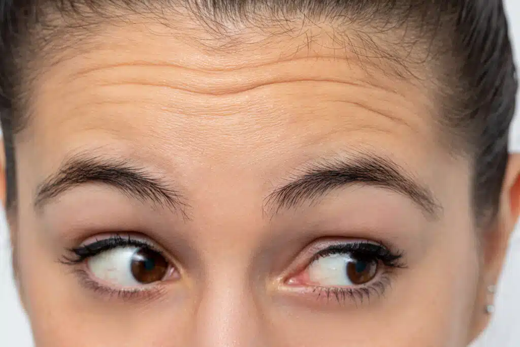 Close-up of a person's forehead and eyebrows, highlighting potential areas for brow lift surgery.