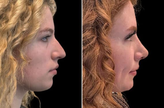 Rhinoplasty Before and After Photos in CA, Irvine, Patient 2109