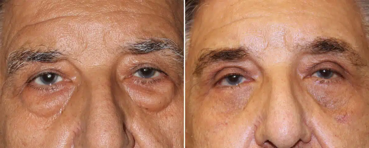 Blepharoplasty Before and After Photos in CA, Irvine, Patient 2043