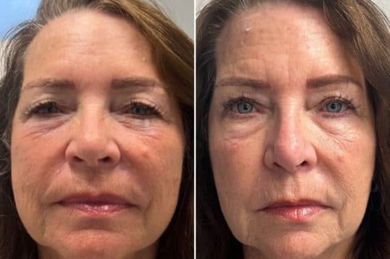 Blepharoplasty Before and After Photos in CA, Irvine, Patient 2213