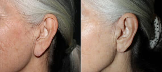 Earlobe Repair Before and After Photos in CA, Irvine, Patient 2220