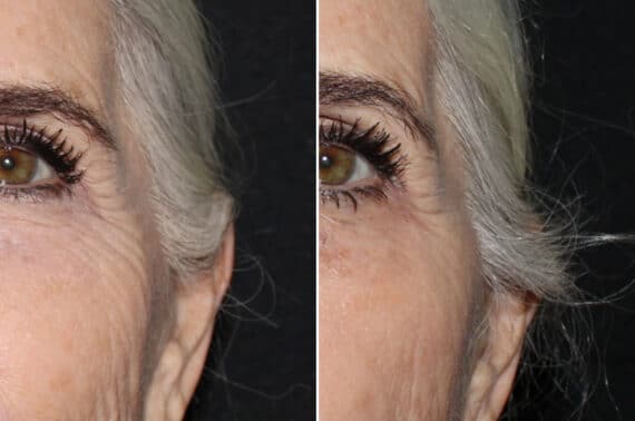 Injectables Before and After Photos in CA, Irvine, Patient 2224