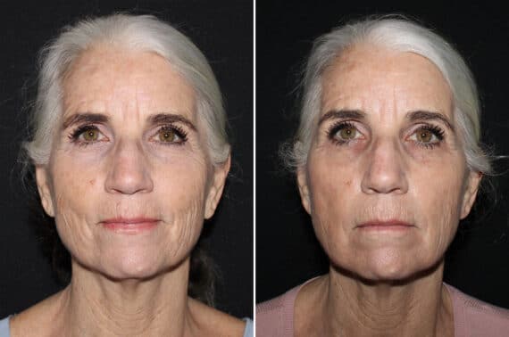 Injectables Before and After Photos in CA, Irvine, Patient 2224