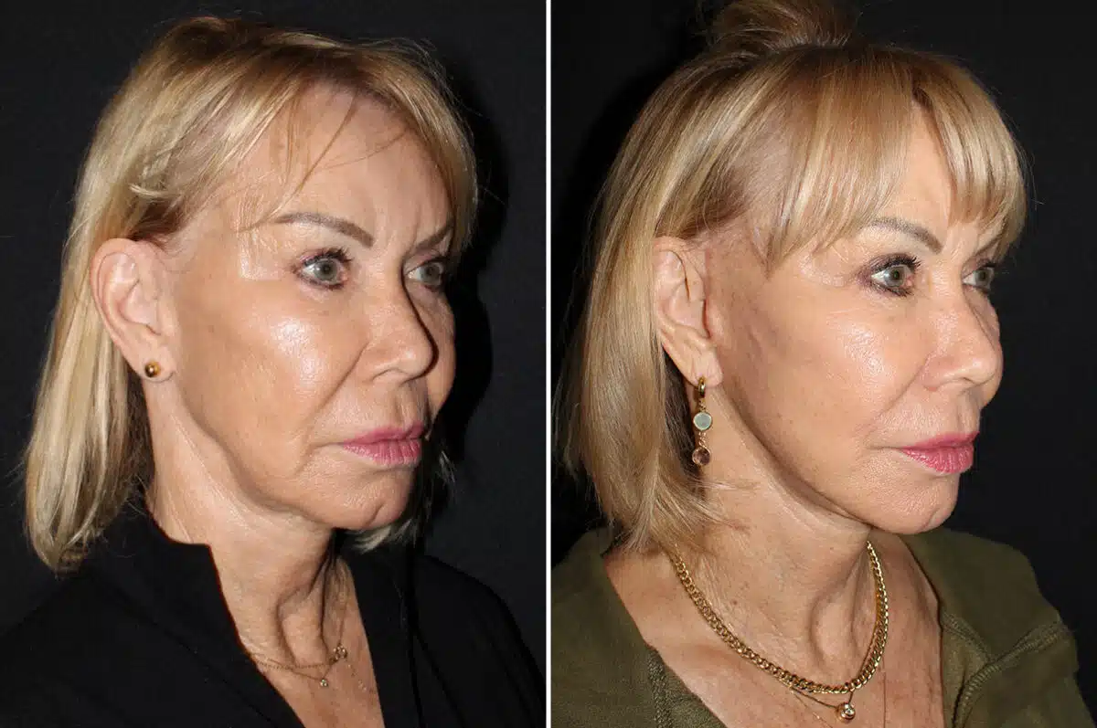 Mini Lift Before and After Photos in CA, Irvine, Patient 2706