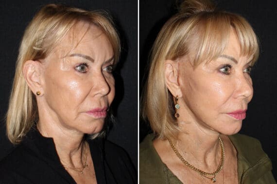 Mini Lift Before and After Photos in CA, Irvine, Patient 2706
