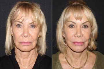 Mini Lift Before and After Photos in CA, Irvine, Patient 2706