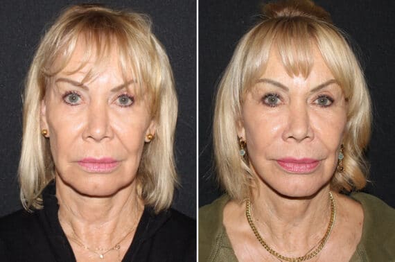 Mini Lift Before and After Photos in CA, Irvine, Patient 2706