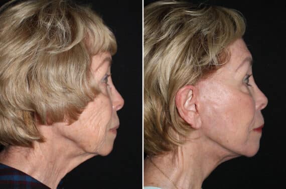 Facelift & Necklift Before and After Photos in CA, Irvine, Patient 2718