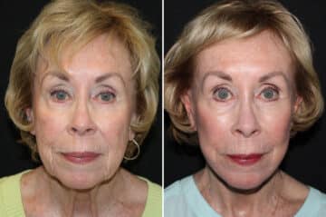 Facelift & Necklift Before and After Photos in CA, Irvine, Patient 2718