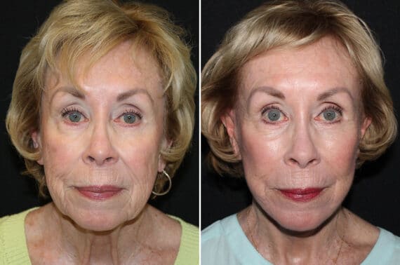 Facelift & Necklift Before and After Photos in CA, Irvine, Patient 2718