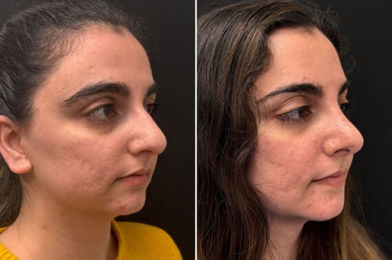 Rhinoplasty Before and After Photos in CA, Irvine, Patient 2725