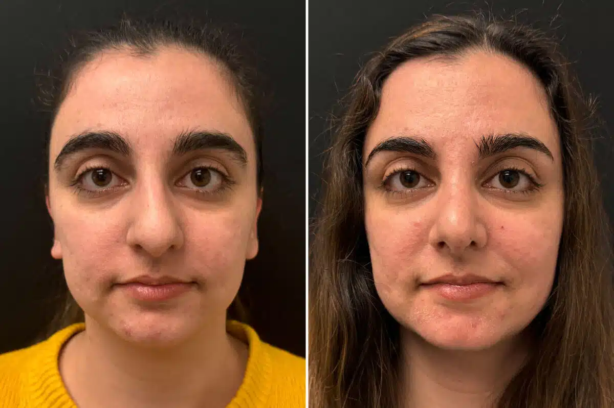 Rhinoplasty Before and After Photos in CA, Irvine, Patient 2725