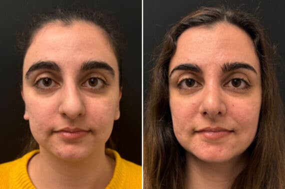 Rhinoplasty Before and After Photos in CA, Irvine, Patient 2725