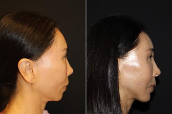 Chin Augmentation Before and After Photos in CA, Irvine, Patient 2713