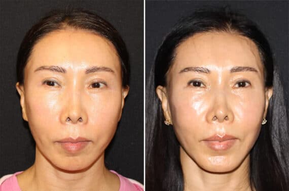 Chin Augmentation Before and After Photos in CA, Irvine, Patient 2713