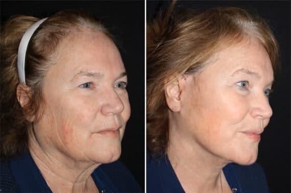 Facelift & Necklift Before and After Photos in CA, Irvine, Patient 2792