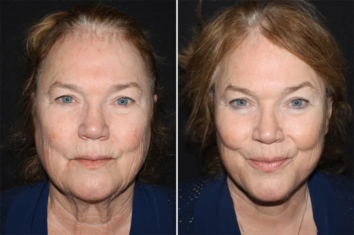 Facelift & Necklift Before and After Photos in CA, Irvine, Patient 2792
