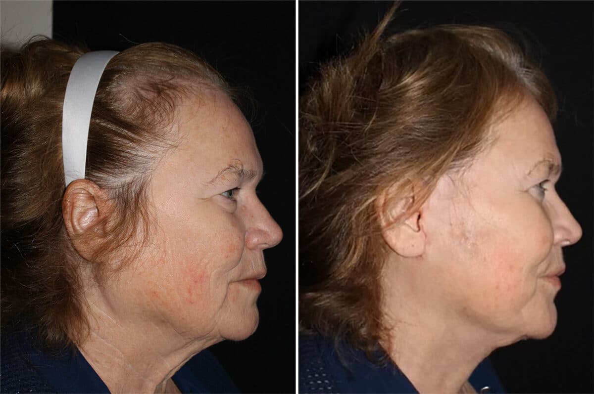 Facelift & Necklift Before and After Photos in CA, Irvine, Patient 2792