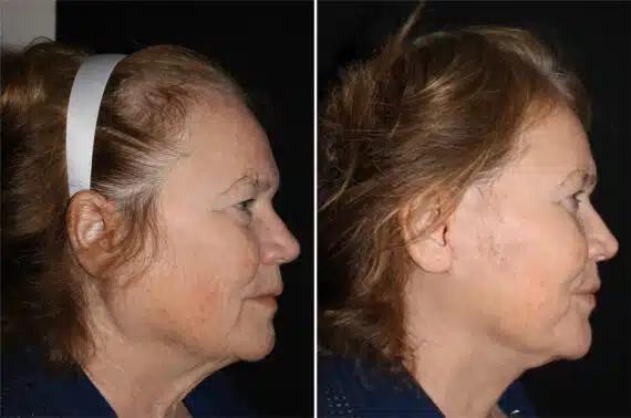 Facelift & Necklift Before and After Photos in CA, Irvine, Patient 2792
