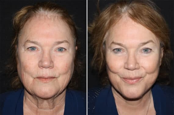 Facelift & Necklift Before and After Photos in CA, Irvine, Patient 2792