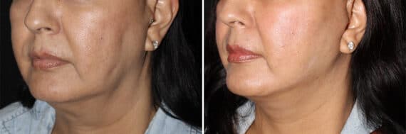 Facelift & Necklift Before and After Photos in CA, Irvine, Patient 2802