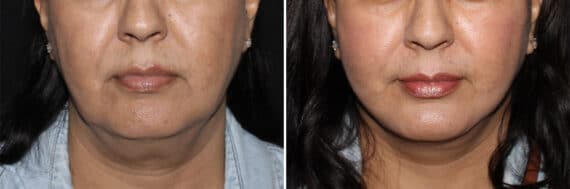 Facelift & Necklift Before and After Photos in CA, Irvine, Patient 2802