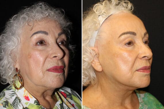 Facelift & Necklift Before and After Photos in CA, Irvine, Patient 2816