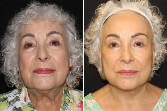 Facelift & Necklift Before and After Photos in CA, Irvine, Patient 2816
