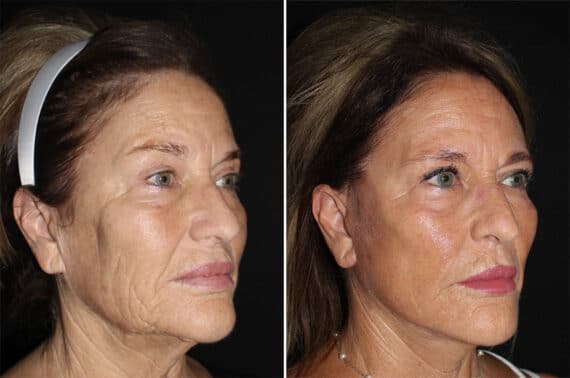 Mini Lift Before and After Photos in CA, Irvine, Patient 2819